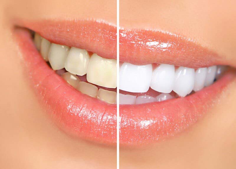 Cosmetic Dentistry in Cypress Texas